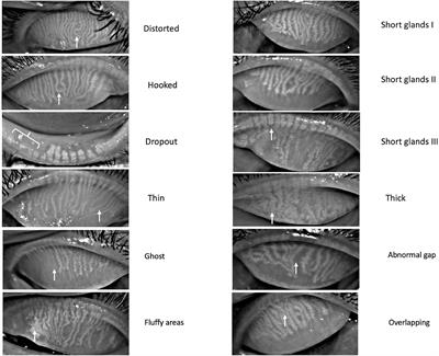 Morphologic variants of Meibomian glands: age-wise distribution and differences between upper and lower eyelids